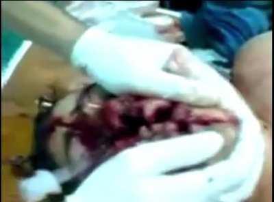 2009 FACE SPLIT DIVING ACCIDENT