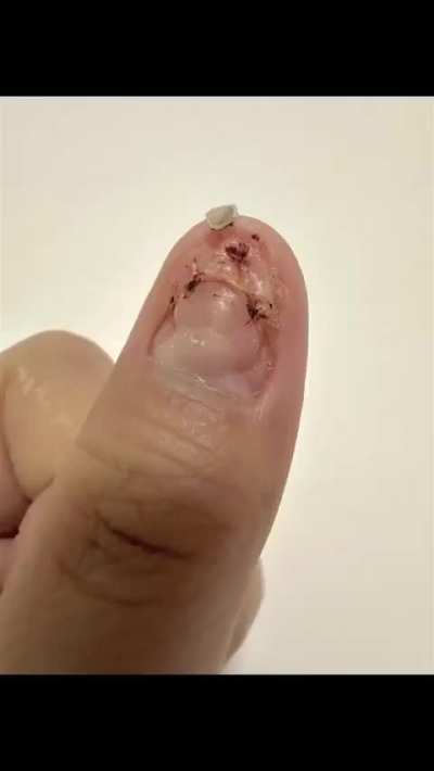 Finger nail regrowth after getting bruised