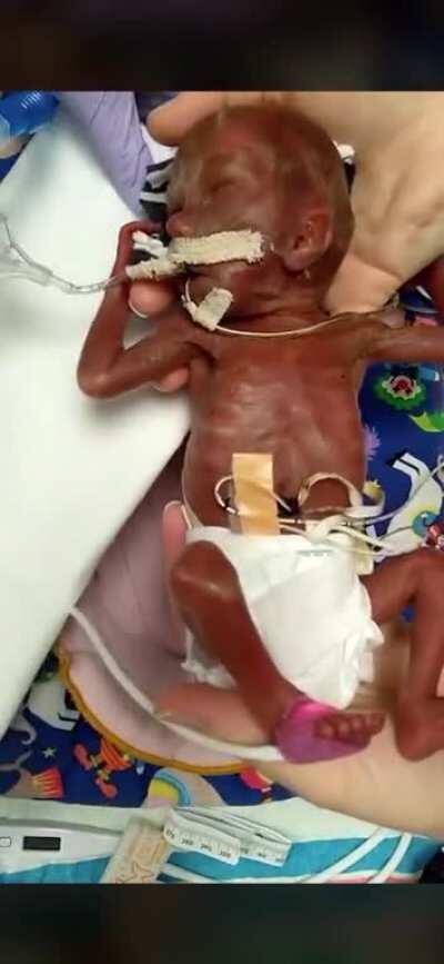 Baby Benson, born at 22 weeks, survives! It would be legal in most states to brutally end his life if he were still in his mothers womb.
