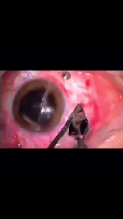 A piece of glass in someone's eye