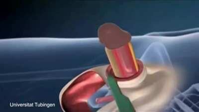 Male to female sex change surgery illustration