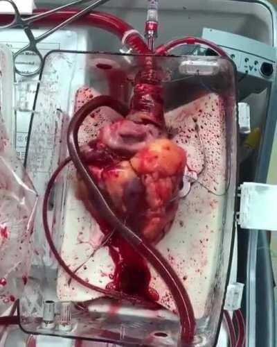 Video of a beating heart awaiting transplant!! This donor heart is using the Organ Transplant System, Heart-in-a-Box.
