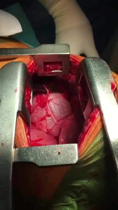 Knife removal near the heart, very close call (Graphic, open chest surgery)
