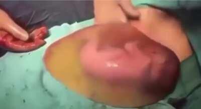 Baby born with intact amniotic sac