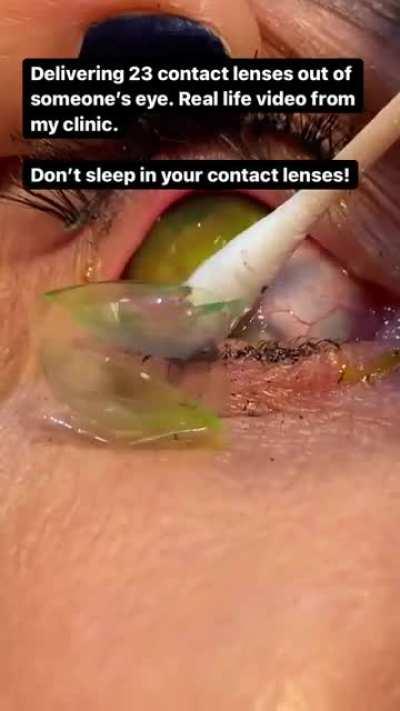 Dr removes 23 contact lenses from eye of a patient who just forgot them
