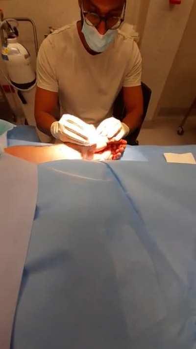 So I sliced an artery accidentally and needed surgery .. got some good distance!