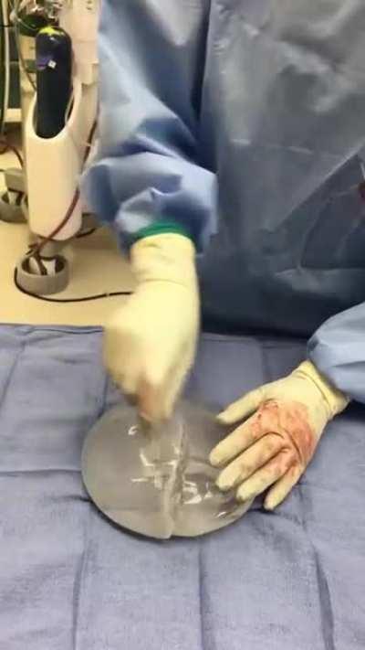 The durability of silicone breast implants.