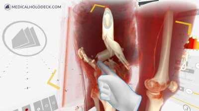 41yo patient's broken leg in Virtual Reality