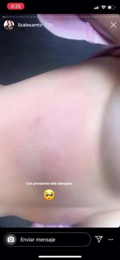 Les presento sus alergias