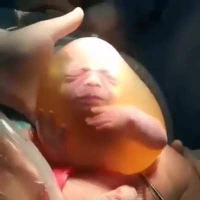 Baby born while still encased in a fully intact amniotic sac!!