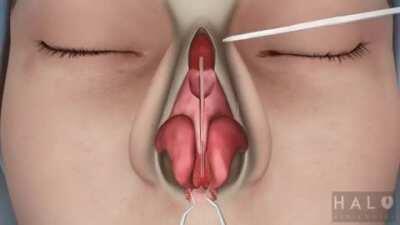 How Rhinoplasty (Nose Job) Is Done