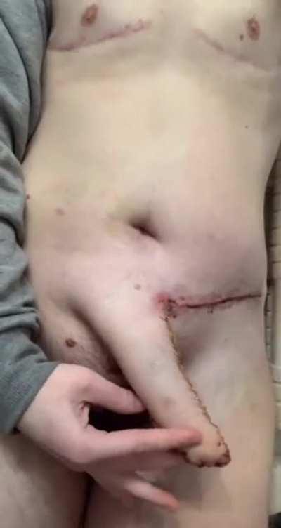 Female to Male surgery aftermath.