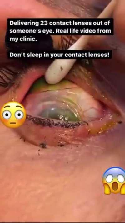 Dont sleep with your contacts on 👀