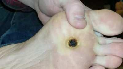 DIY high-voltage electrosurgery on my plantar wart