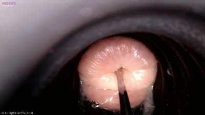 cervix wrinkles as large sounding rod pushes inside