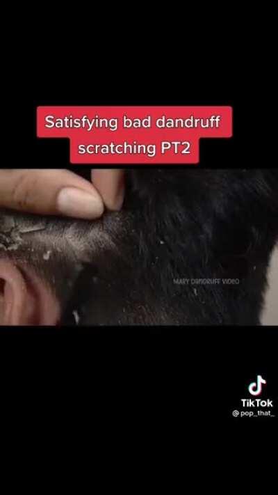 Satisfying dandruff scratching