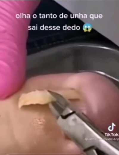 crazy ingrown tornail