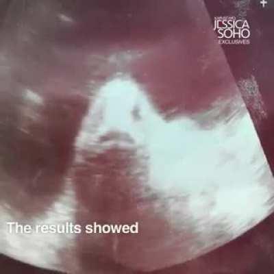 A woman pregnant with fish