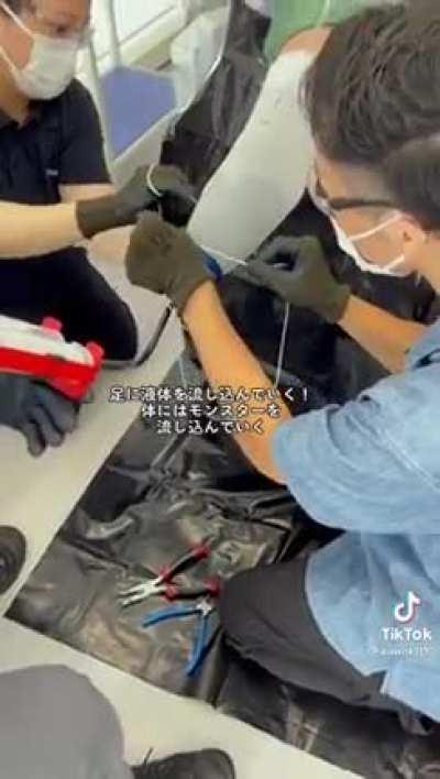 Amputee gets a prosthesis upgrade