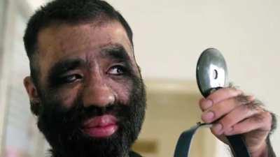 World's most hairiest man