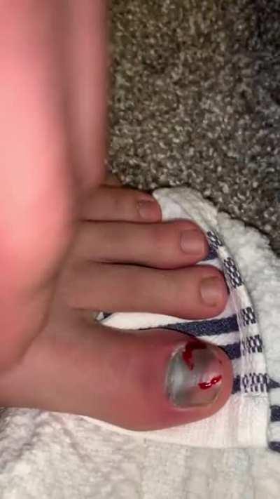 Dropped a bench on my toe when moving...