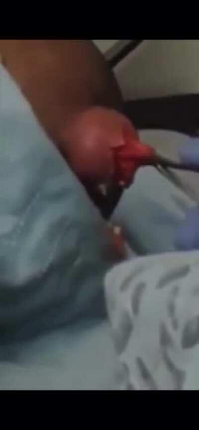 Popping a HUGE pimple(?) on a head.