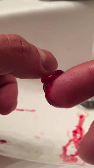 Got out of an Uber and shut the door closed on my finger, then ripped it out of the door. Shattered the tip of the finger, then tried to remove the nail myself after getting home.