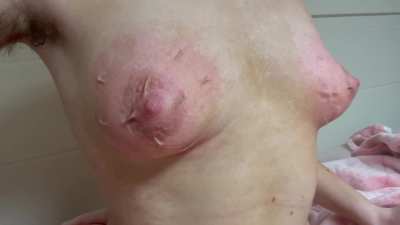 my little tits after i covered them in clothespins