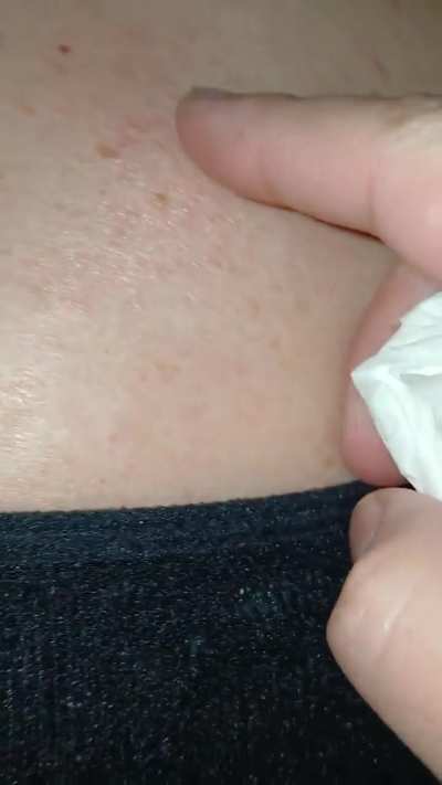 Found on a pimple popping sub... (nsfw for pus and a lil blood, obviously)