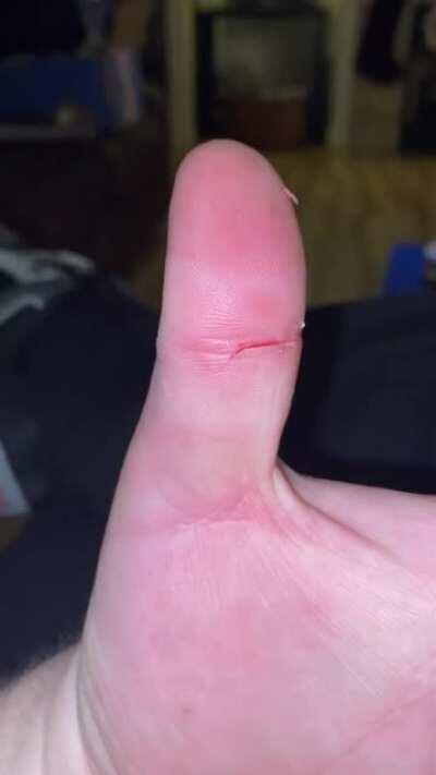 Plastic cut the crook of my thumb