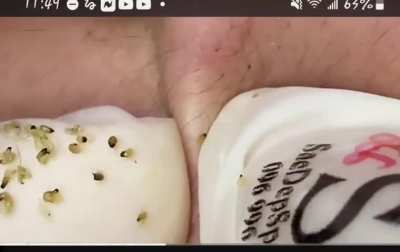 Little teeny tiny blackheads