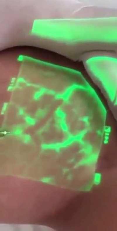 VeinViewer is a technology that helps physicians and nurses see a patient's veins.