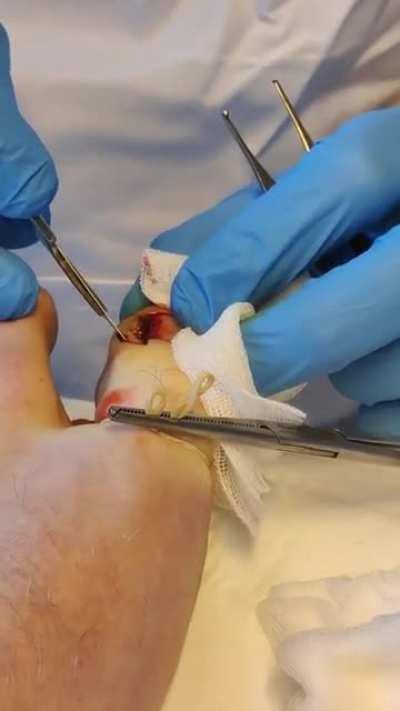 Surgery removal of my ingrown toenail. Doc took away a whole chunk. Took the chunk home. Fainted right after the video