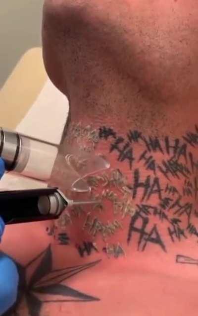 Tattoo removing