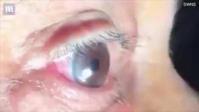 15cm long parasite is removed from mans eye