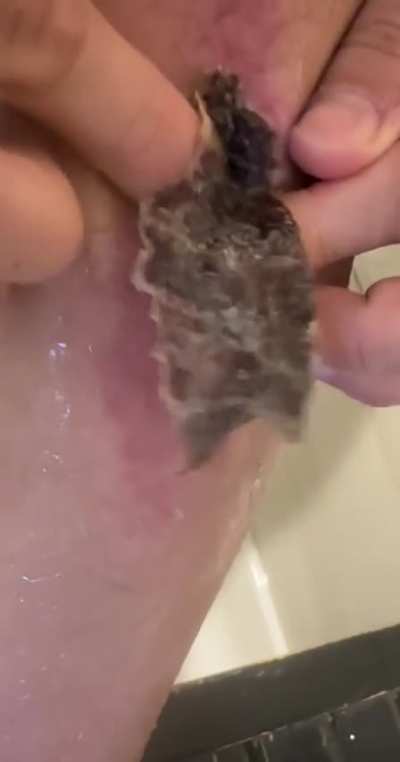 The whole scab just came off