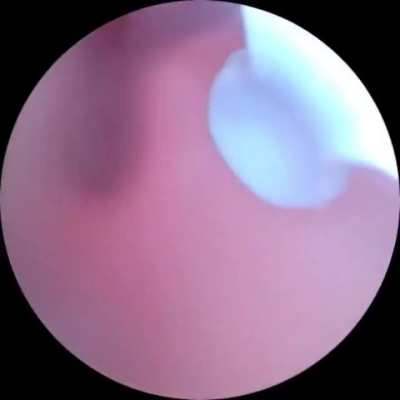 Ear pimple pop