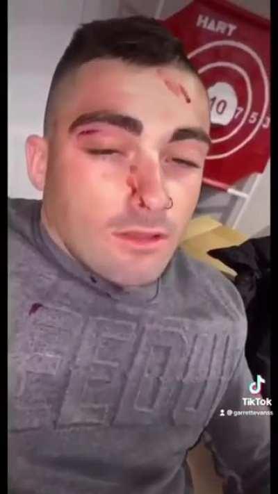 Jumping onto a pole at full speed and trying to show off