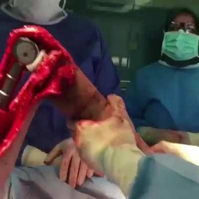 Quick mobility assessment! The patient underwent a complete excision of the femur and received a total femoral endoprosthetic replacement due to osteosarcoma of the bone. Currently, the patient is alive and shows no signs of disease recurrence