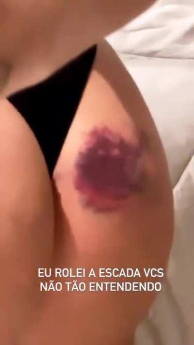 Manoo tadinha... Viih Tube... 🥺🙏 Oremos pra esse bumbum sarar rápidinho...