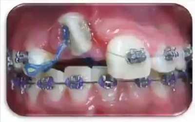 Gross yet fascinating. Wait till the end, modern dentistry is amazing!