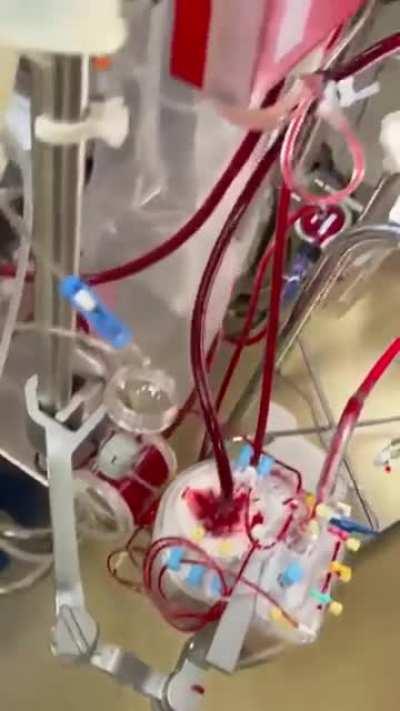 A heart that will be transplanted.