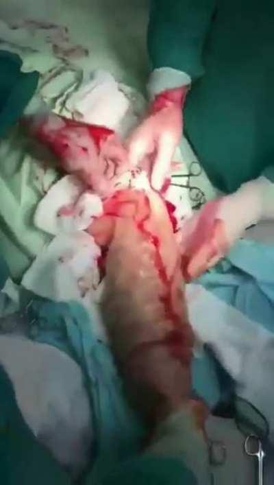 Surgically removing a dildo.