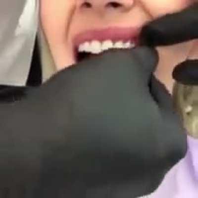 This woman is having porcelain teeth fitted.