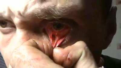 Schizophrenic person trying to remove camera from eye.