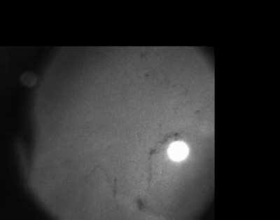 Detailed photo of a large floater in my right eye showing multiple clumps and filaments