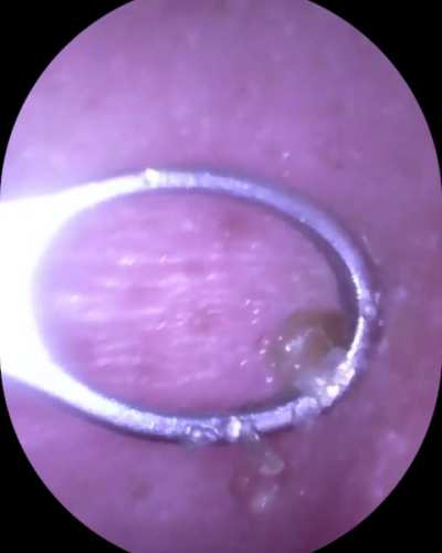 Ear blackhead removal