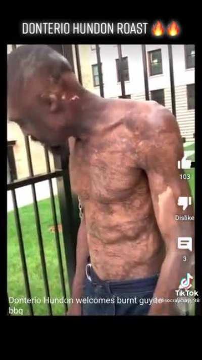 Making fun of a burn victim