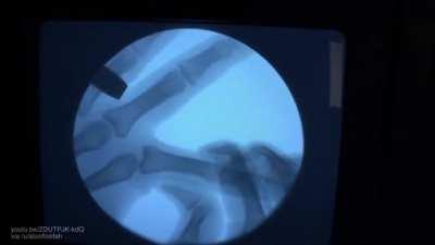 Cracking knuckles under a fluoroscope