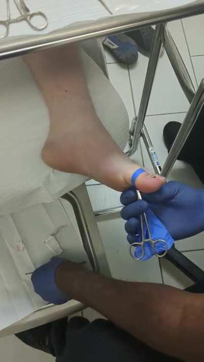Toenail Removal 